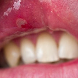 WHAT CAUSES MOUTH ULCERS AND HOW TO TREAT THEM?