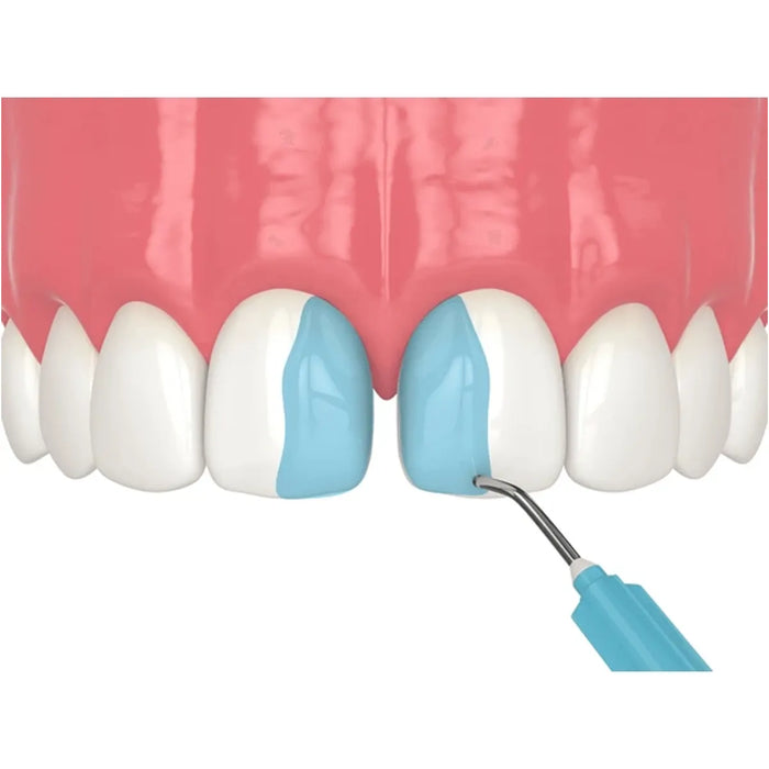 Ivoclar N-Etch Refill 2x2 g
