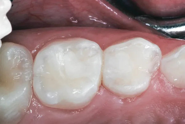 D-Tech Restore + Condensable Restorative Cement