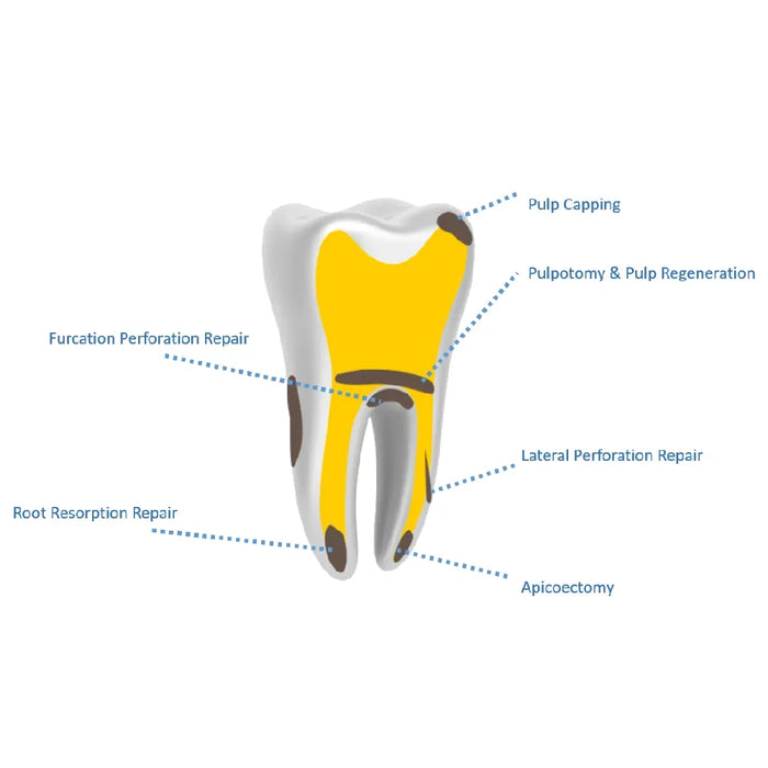 Kids-e-Dental E-MTA Putty