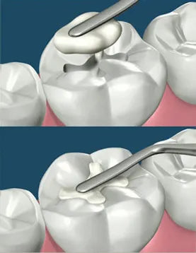 3m Espe Filtek Z350 XT Restorative Syringe - pack of (1 syringe :4g)