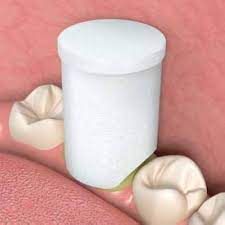 premier dental retraction cap