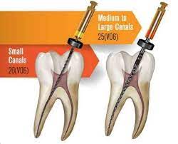 ss white exact taper h endodontic files