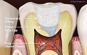 vishal dentocare v ‐ pulp cure