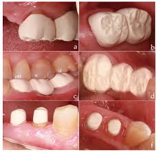 huge synthetic polymer teeth : sonning