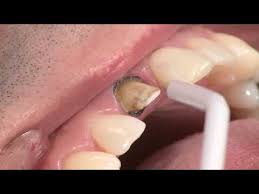 Ultradent Intraoral Tips