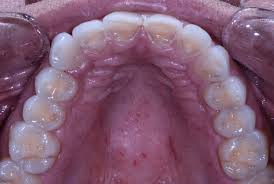 vishal dentocare  gingicare gel