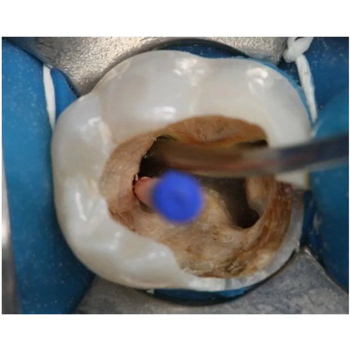 angelus mta (2 doses) (824)