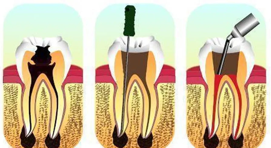 Maarc D-Vitz Pulp Devitalizer 3gm Syringe