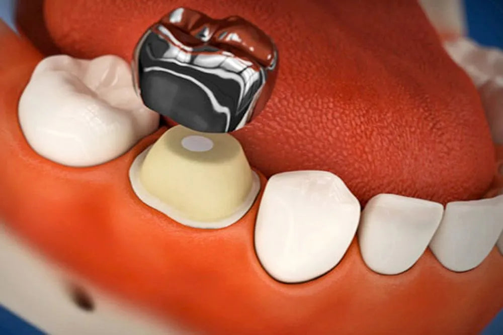 3m espe stainless steel primary crown e ( 2nd molar) - pack of 1 pair