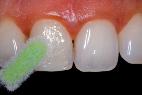 ivoclar fluor protector dental varnish