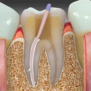 safe endo bioactive rcs